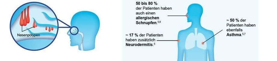 Häufige Begleiterkrankungen der chronischen Nasennebenhöhlenentzündung mit Nasenpolypen