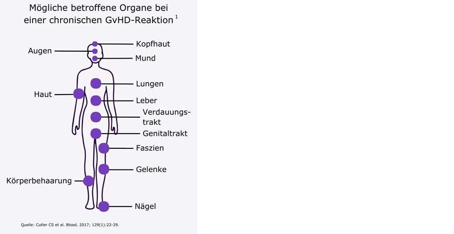 Vielfältige Symptomatik bei der Chronischen Graft-versus-Host-Erkrankung