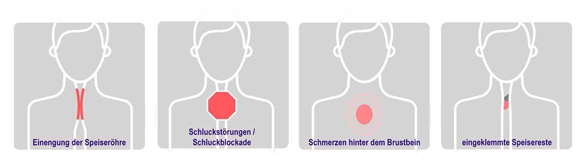 Typische Symptome bei Erwachsenen und Jugendlichen mit EoE.