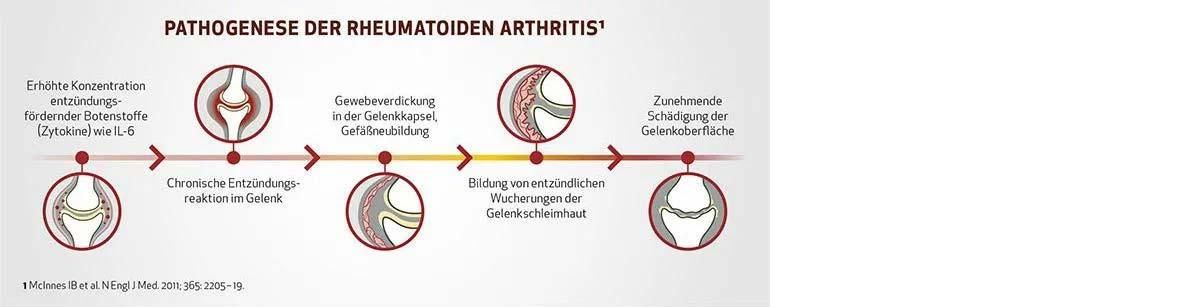 Grafische Darstellung der Pathogenese der Rheumatoiden Arthritis